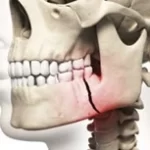 Bone tissue engineering and Regenerative medicine