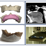 Patient Specific Implants